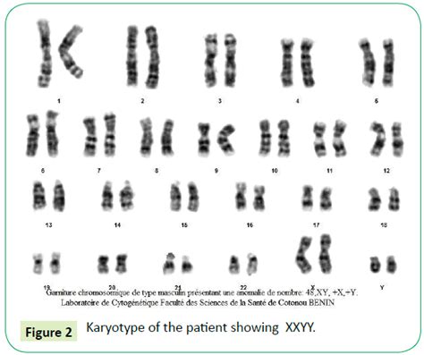 xxyy syndrome name|xxyy syndrome characteristics.